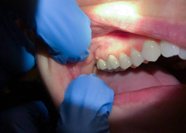 Best Emergency Treatment for Dental Infections or Abscesses in Legend Lake, WI